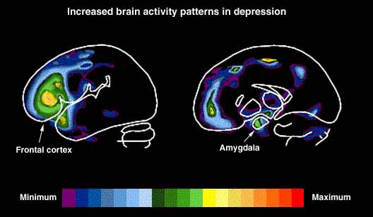 prozac for anxiety in child